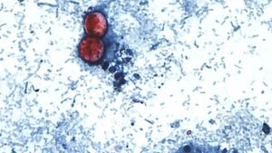 Cyclospora Outbreak